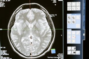 איך להתכונן לבדיקת CT ראש