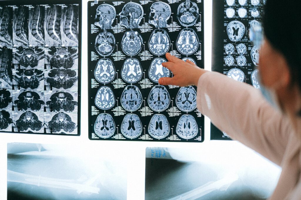 MRI מוח