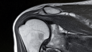MRI כתף